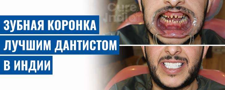 зубные коронки